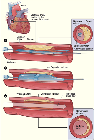 經皮冠狀動脈介入治療(圖1)