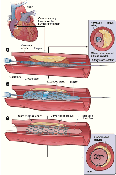 經皮冠狀動脈介入治療(圖2)